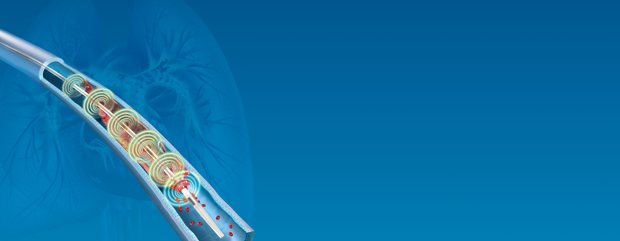 Vascular Surgery Boston Scientific